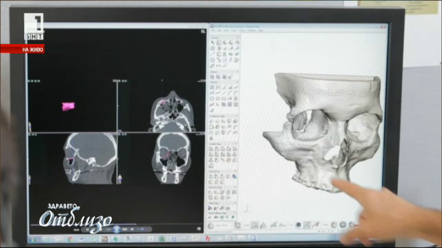 Присаждане на 3D принтиран титаниев лицев имплант