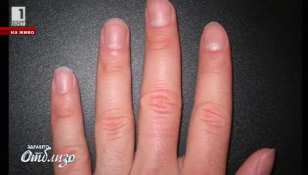 Диагноза по ноктите